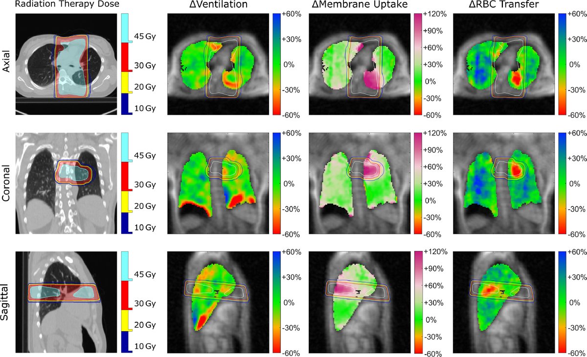 New #RedJournal research: Radiation-induced lung injury visualized and quantified using hyperpolarized-xenon MRI - will deepen understanding of using RT for lung cancer. @UNCRadOnc @DukeMedPhys #LungCancer #RadiationTherapy #MRI #Xe bit.ly/redrankine1