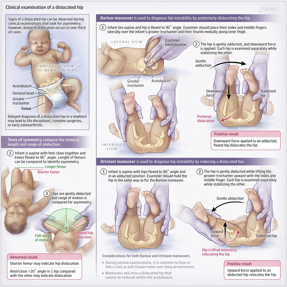 Systematic review evaluated the diagnostic accuracy of clinical examination in determining a dislocated hip in infants. ja.ma/440X0ZV