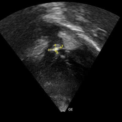 #PediatricCardiology: Unveiling insights into infective endocarditis among infants! 🚑 Read how a one-year-old with tetralogy of Fallot showcased isolated pulmonary valve vegetations. bit.ly/3VYZlCD #MedEd #Cardiology #Research #MedTwitter