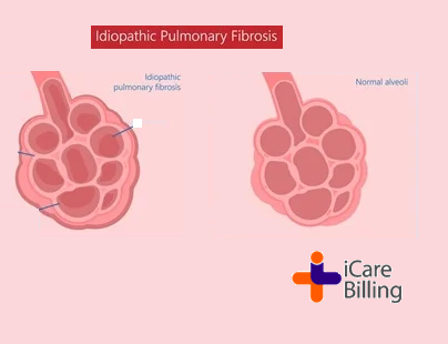 Idiopathic pulmonary fibrosis (IPF) is the most common type of pulmonary fibrosis.  It is a disease that causes scarring (fibrosis) of the lungs. The word 'idiopathic' means it has no known cause.                      
#icarebilling, an American #HealthcareIT company