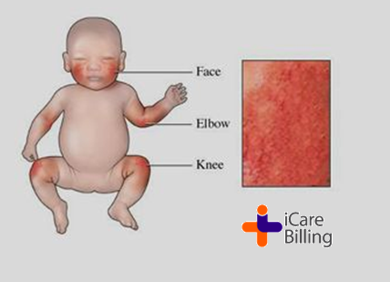 Impetigo is a common and highly contagious skin infection that mainly affects infants and young children. It usually appears around the nose and on the hands and feet. Over about a week, the sores burst and develop honey-colored crusts.       
#icarebilling, the best #RCM Company