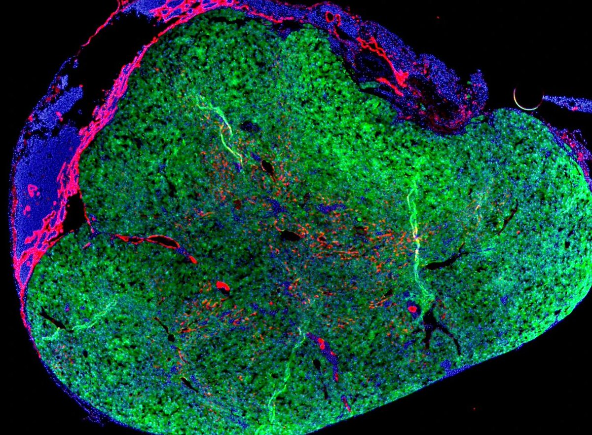 A ‘#MiniLiver’ will grow in a human’s own lymph node in a bold new trial! 🤯 

The procedure, developed by <a href="/LyGenesis_Inc/">LyGenesis</a>, marks the beginning of a #ClinicalTrial for people whose livers are failing, but who have not received an organ transplant.

🔗: go.nature.com/4ajalyR