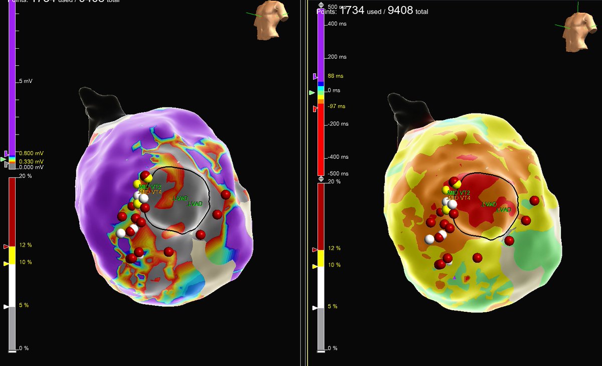 MEfraimidis's tweet photo. Scar-related multiple VTs with different morphologies from the inflow cannula site in a pt with LVAD @ipetemil @K_Letsas @SteliosDragasis @athsaplaouras @Kariki_O @BellosPeriklis https://t.co/4ylh2rgHMO