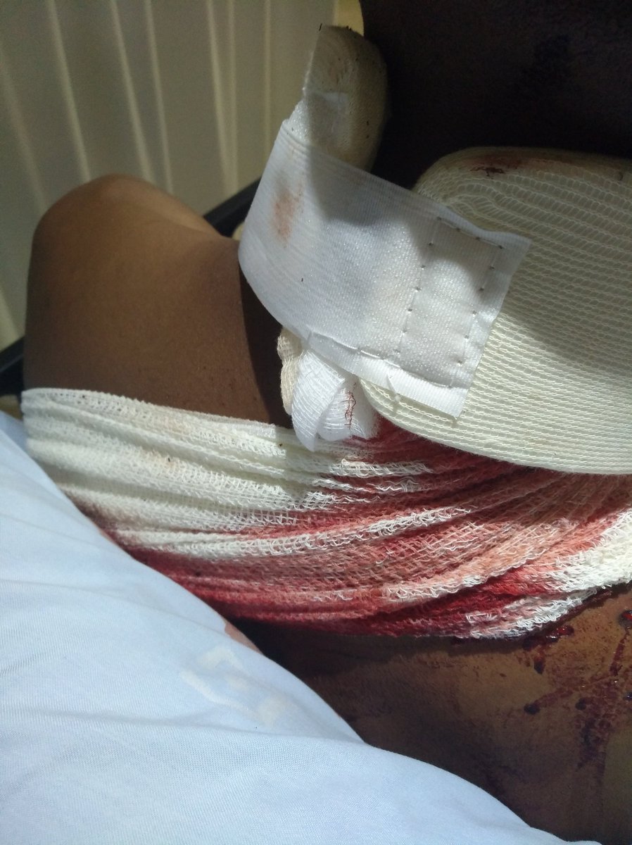 tycullmaddavee's tweet photo. It is has bn 3yrs6mnths, since 27 Oct 2020, when I was severely shot at with a riffle &amp; pistol by Leandra SAPS, in Mp, mistaken Id shooting while on my way 2 wrk to make an honest living! Up 2 this date Ipid dazn't want 2 release da ballistic report! The State is silent. @IPID_ZA https://t.co/S6MFvjeQfq