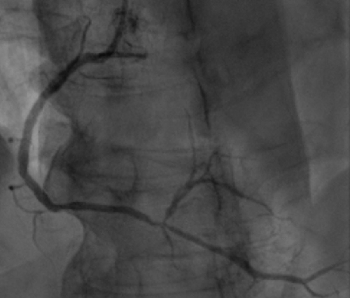 ✨Ultra-Low Contrast PCI for bifurcation lesions: Case-based #Tweetorial 👇 Diagnostic image below with lesion in RCA/rPDA/rPL bifurcation. Creatinine = 3.1 Total contrast use = 3 cc (final cine) 1/10🧵 #CardioTwitter #ACCFIT #Cardiology #CardioEd