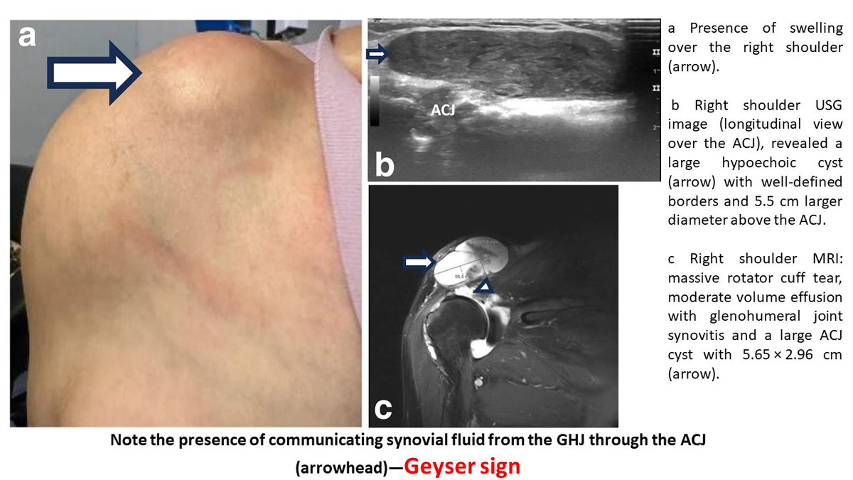 📌Geiser sign in a patient with #rheumatoidarthritis ✅This case is an example of a rare manifestation of rotator cuff tear associated with osteoarthritis of the ACJ and synovitis of the GHJ in a patient with RA. 👉rdcu.be/dEOXW