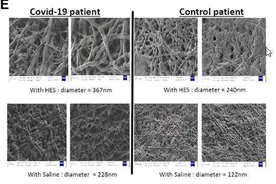 🩸Dr. Rezigue and team report that hydroxyethyl starch (HES) may enhance in vitro fibrinolysis in severe #COVID19 samples, potentially aiding against COVID-19-induced #VTE. HES could be considered as a supportive therapy, pending further evaluation.

🔗rpthjournal.org/article/S2475-…