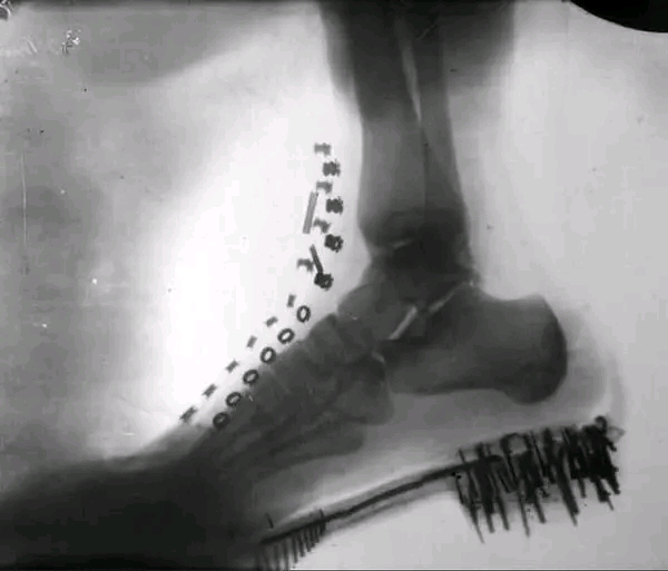 Driven by mysterious damage to photographic plates, Nikola Tesla began his investigation of x-rays (at that time still unknown and unnamed) in 1894. This shadow-graph of a human foot in a shoe was obtained by Tesla in 1896 with x-rays.