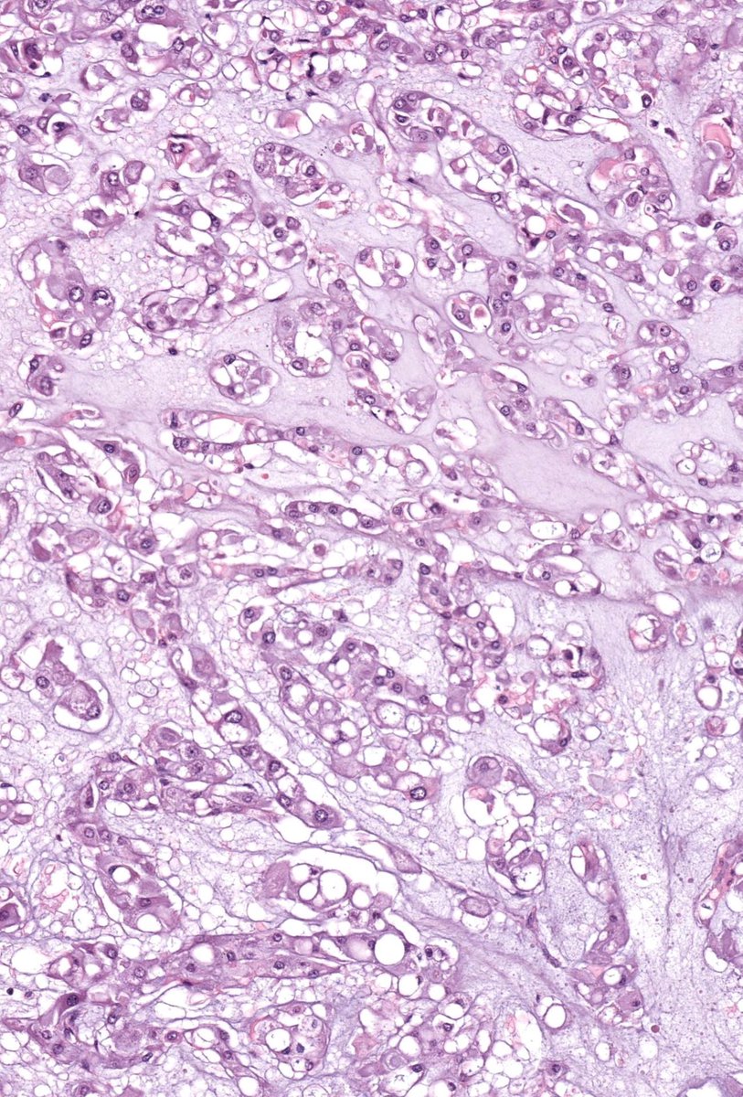 Sacral mass. Adult. Diagnosis?
Digital slide: kikoxp.com/posts/20299
Answer ✅ youtube.com/watch?v=vR5k9z… 
Another great example: kikoxp.com/posts/8265
#neuropath #BSTpath #pathologists #pathology #pathTwitter