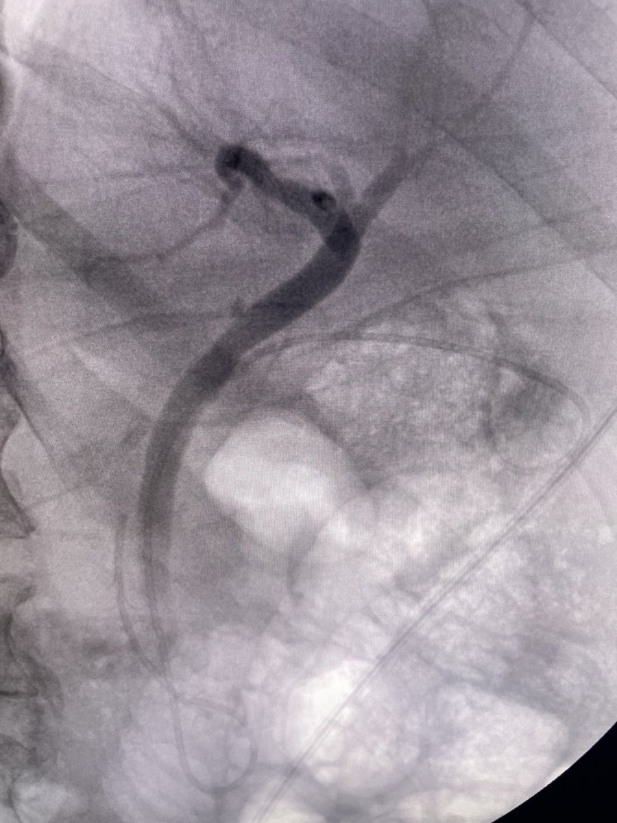 Elderly patient with dementia, cholecystitis, and sepsis. Surgery declined cholecystectomy. Gall bladder not in good position for transmural drainage. Gallbladder accessed by a cystic duct and drained with a double pigtail stent. #gitwitter #surgery #medtwitter