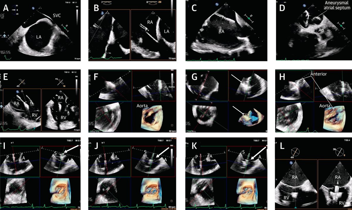 JACC Journals (@jaccjournals) on Twitter photo #JACCIMG presents novel intraprocedural 3D ICE navigation for #tricuspid transcatheter edge-to-edge repair. bit.ly/3xyGIvg
#TEER #cvVHD #EchoFirst #cvImaging <a href="/HamidNadira/">Nadira Hamid</a> #JACCIMG presents novel intraprocedural 3D ICE navigation for #tricuspid transcatheter edge-to-edge repair. bit.ly/3xyGIvg
#TEER #cvVHD #EchoFirst #cvImaging <a href="/HamidNadira/">Nadira Hamid</a>