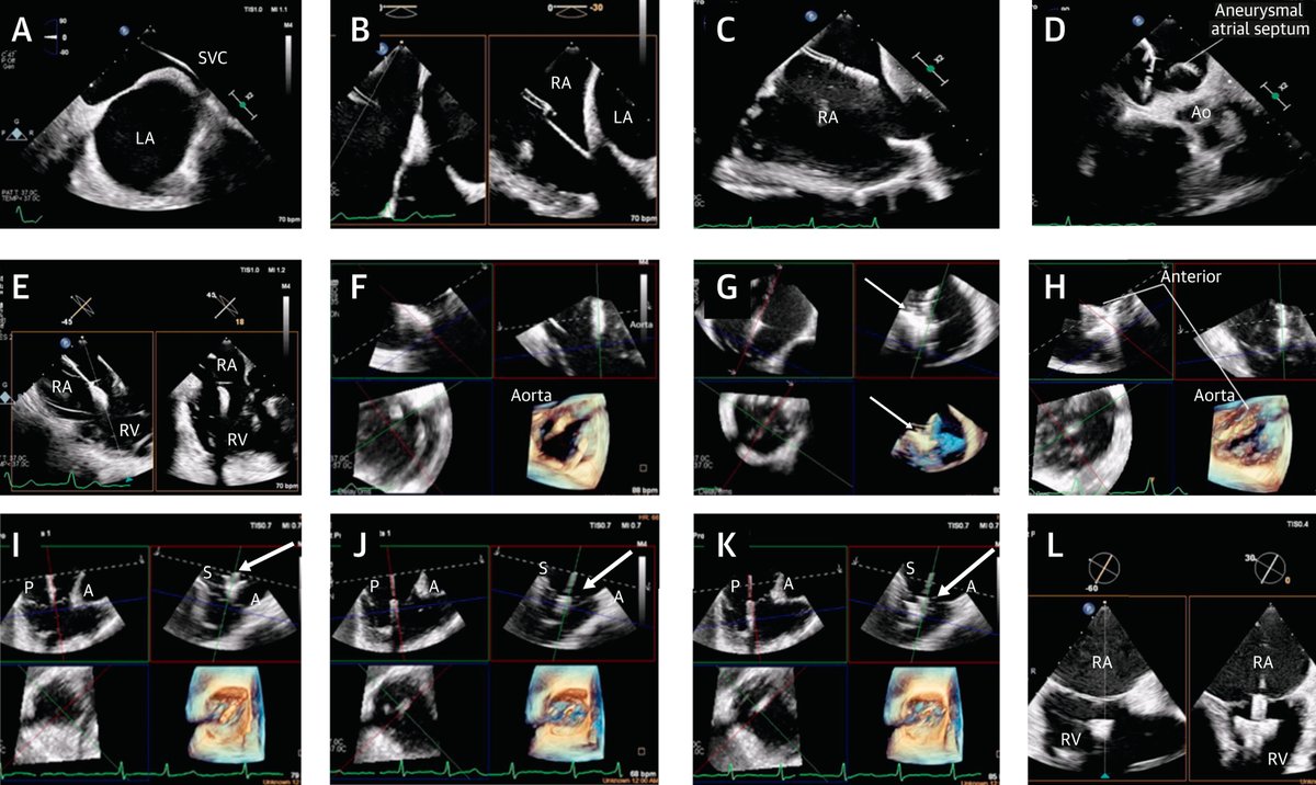 #JACCIMG presents novel intraprocedural 3D ICE navigation for #tricuspid transcatheter edge-to-edge repair. bit.ly/3xyGIvg

#TEER #cvVHD #EchoFirst #cvImaging @HamidNadira