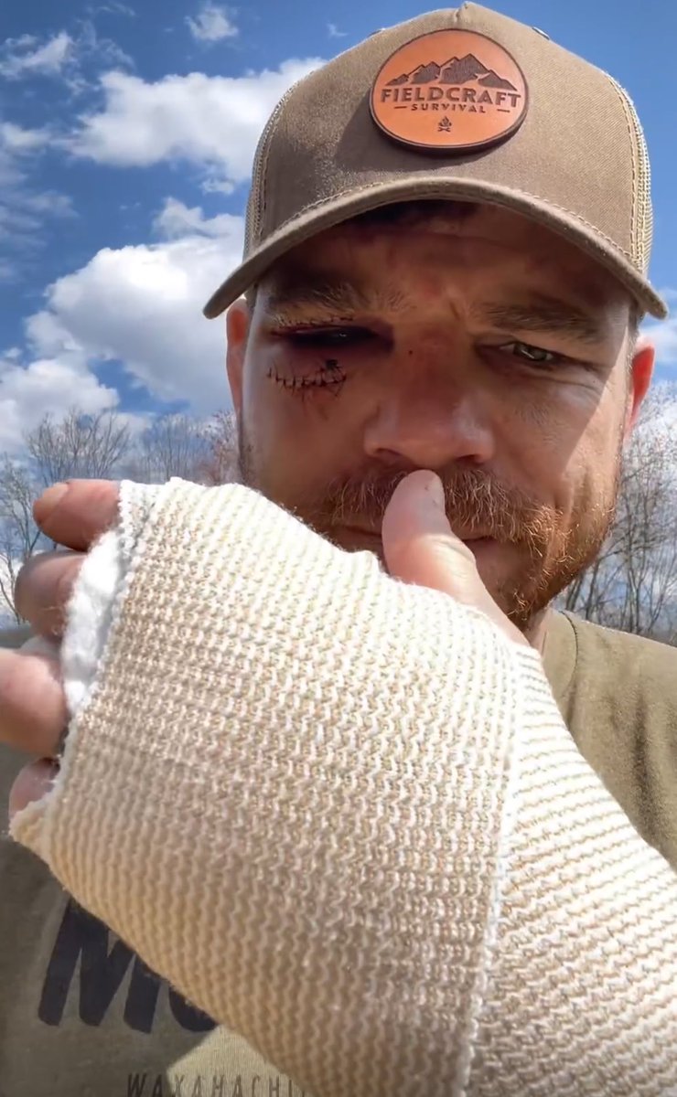 🚨| Jim Miller broke his hand in the first round, broke his toe and received 23 stitches during and after his loss to Bobby Green at #UFC300.