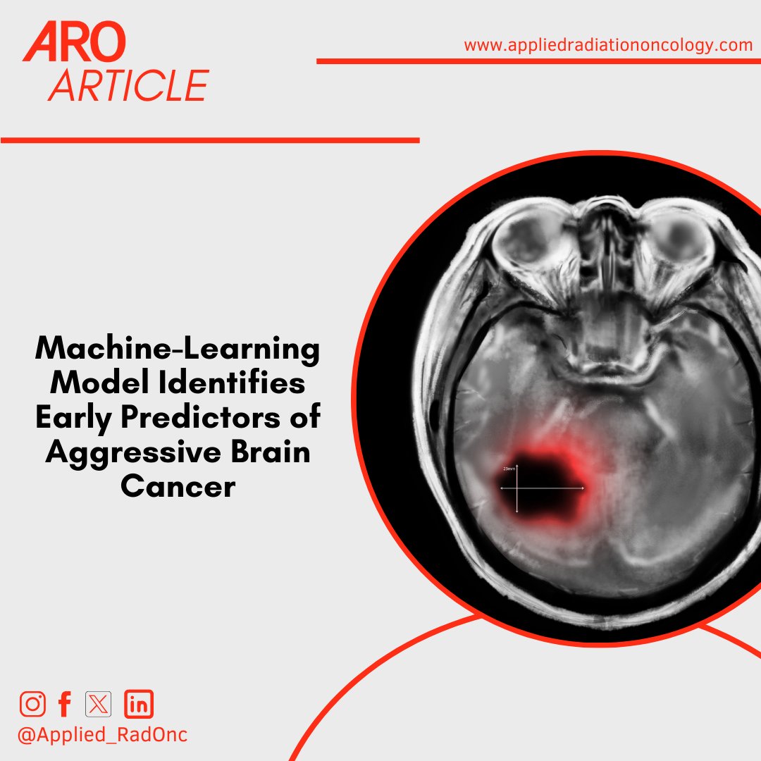 Machine-Learning Model Identifies Early Predictors of Aggressive Brain Cancer 🧠 Learn more ➡️ bit.ly/43fpiiO #RadOncEd #MachineLearning #BrainCancer #AI #HeadAndNeckCancer #OHANCAW #CancerAwareness
