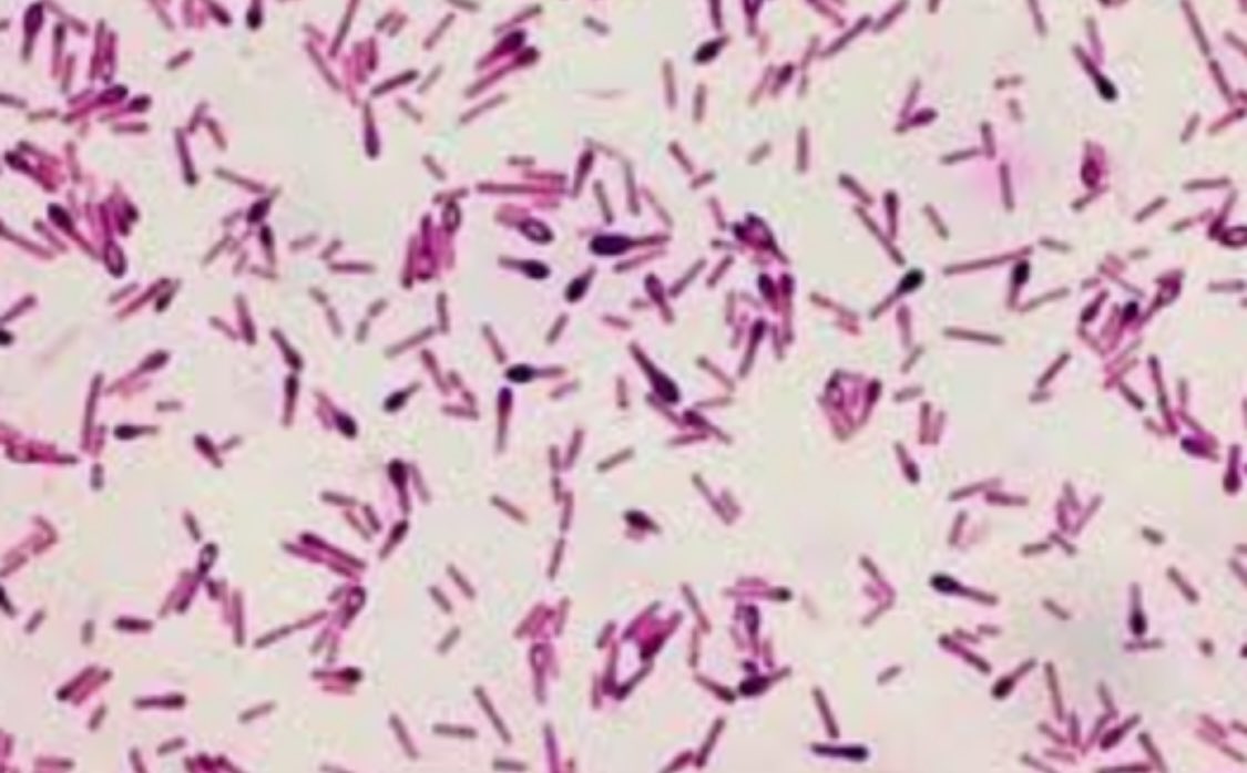 #idboardreview 30 M recently injected black tar heroin subcutaneously w/ blurred vision, double visionx 12hrs. weakness of arms, legs giving out x6hrs. Now +dyspnea. no GI sx, afebrile, puncture site tender, dilated pupils, CN3,4,6 impaired. diganosis? #idmedEd #idxposts