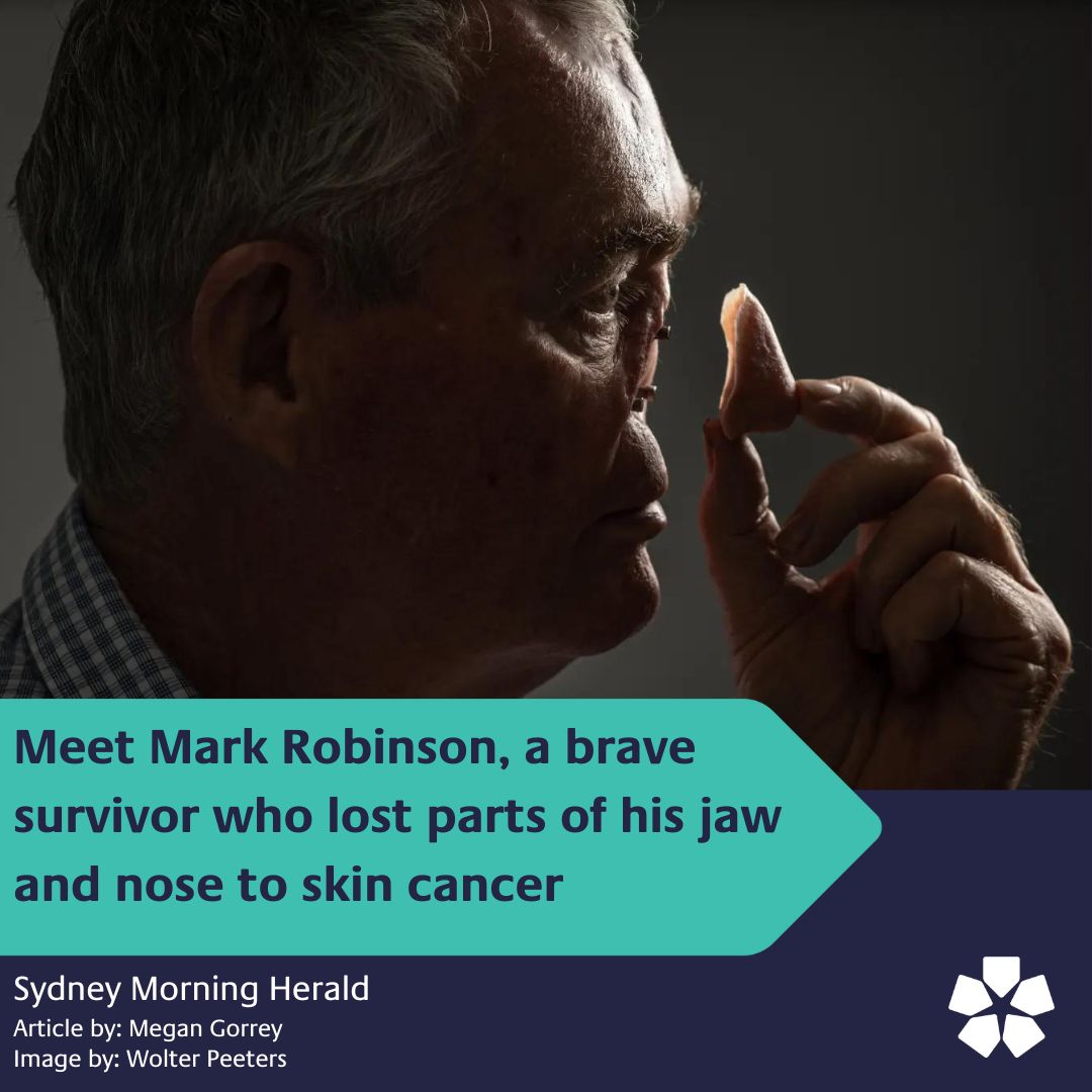 Mark Robinson, a brave survivor and Chris O'Brien Lifehouse patient lost parts of his jaw and nose to skin cancer. He was recently featured in an article by The Sydney Morning Herald (@smh). Follow the link for more information, smh.com.au/national/nsw/c… @IntegProsRecon