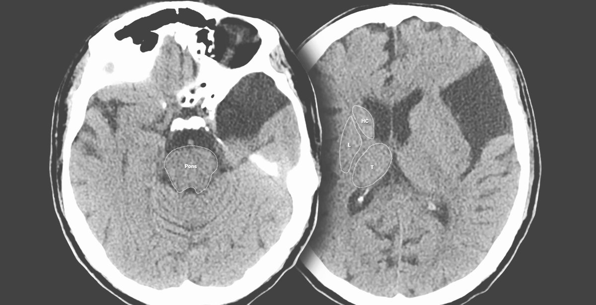 What is your diagnosis?

#Radiology #MedTwitter #MedX #ct 
#MedClips