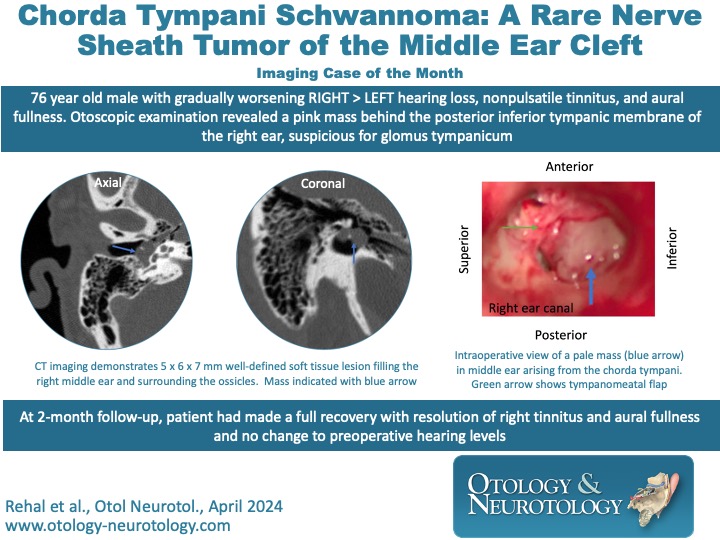 Imaging case of the month: chorda tympani #schwannoma of the middle ear.  #Otology. ow.ly/FRmq50Ra2gx