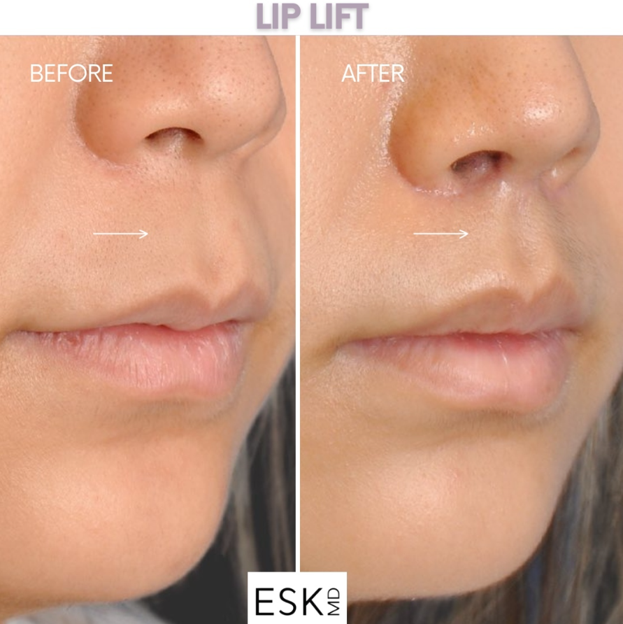 Our patient is so happy with the results from their #liplift *and* how the scarring is practically invisible!

#drkwak #dredwardskwak #eskmd #plasticsurgeon #nycplasticsurgeon #plasticsurgeons #plasticsurgery #plasticsurgerybeforeandafter #liplifting #lipliftsurgery