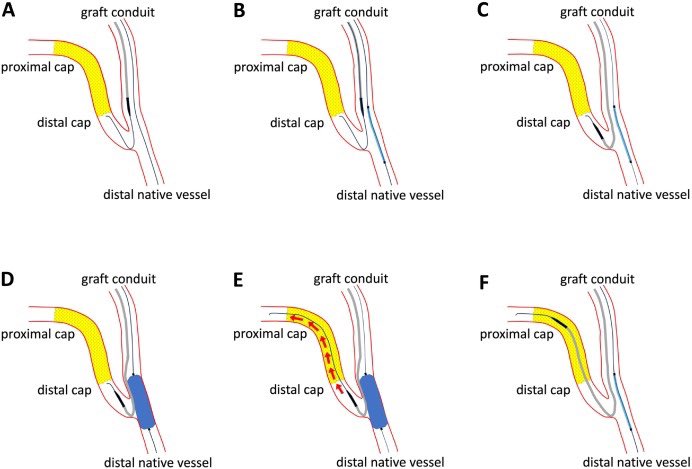 Our microcatheter anchor technique (MAT) published. Working around retroflexed graft insertion sites can be difficult. MAT adds to our current balloon anchor toolbox (eg BASE and side BASE) and can be used for wiring, MC tracking in other difficult coronary anatomies.