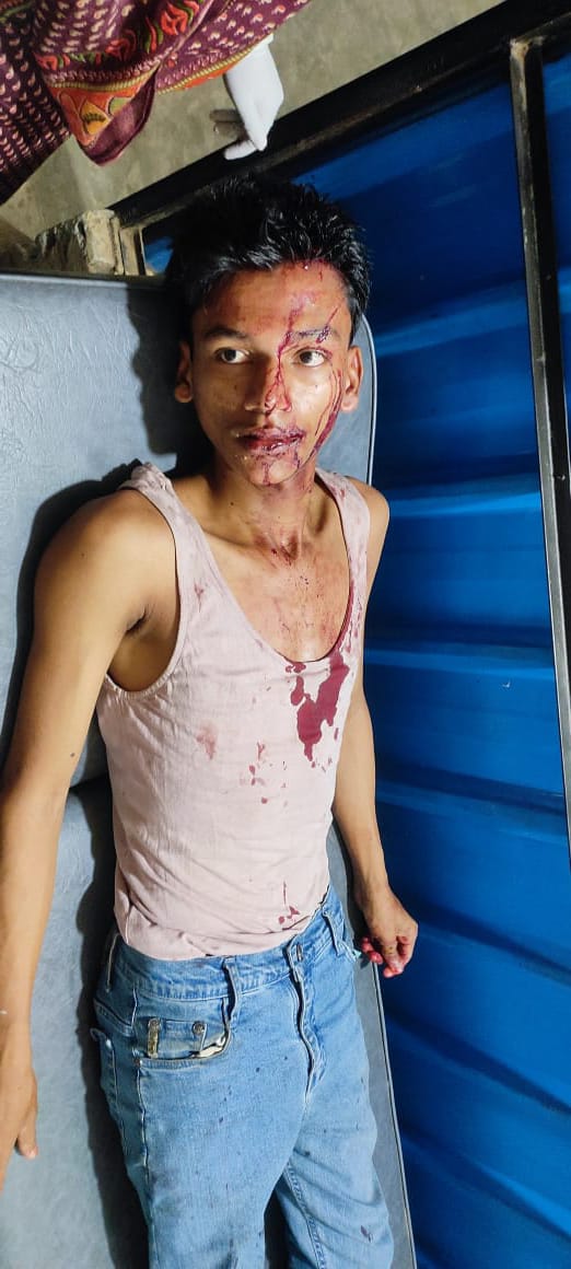 TawkiRo's tweet photo. Monjur Alam, a #Rohingya teacher, was heavily tortured last night by members of an armed group in camp-1. He is now in critical condition. Previously, his father was fatally attacked in camp-4. Despite relocating to camp-1 for his safety, he continues to face dire circumstances. https://t.co/uGP4WmNfwf
