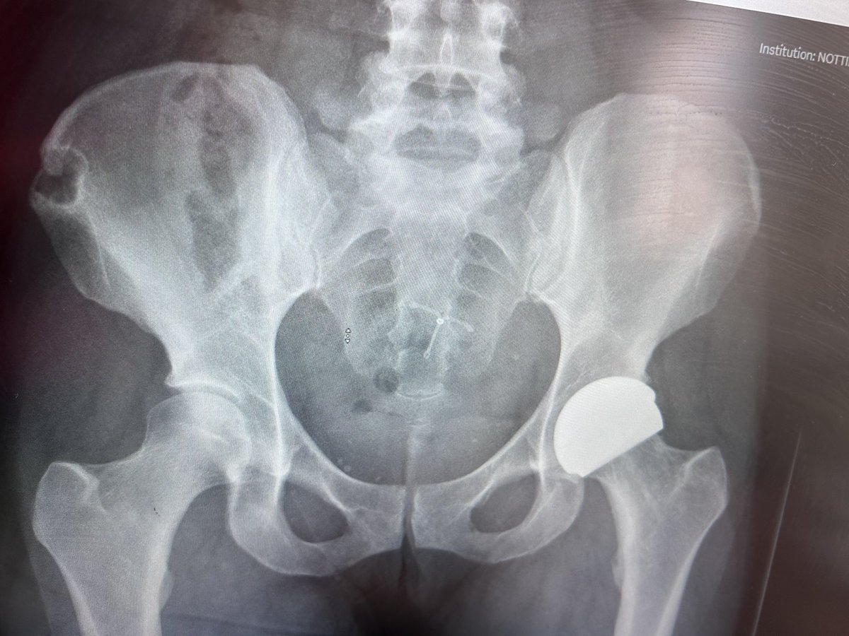 One year post operation …. 
Super grateful to this amazing surgeon Mr Andrew Manktelow and his team… i am so fortunate to be given a hip resurface as part of his hip replacement study..  #grateful #secondchance ❤️💪🙏 Ceramic hip resurfaces are the way forward!@AndrewManktelow