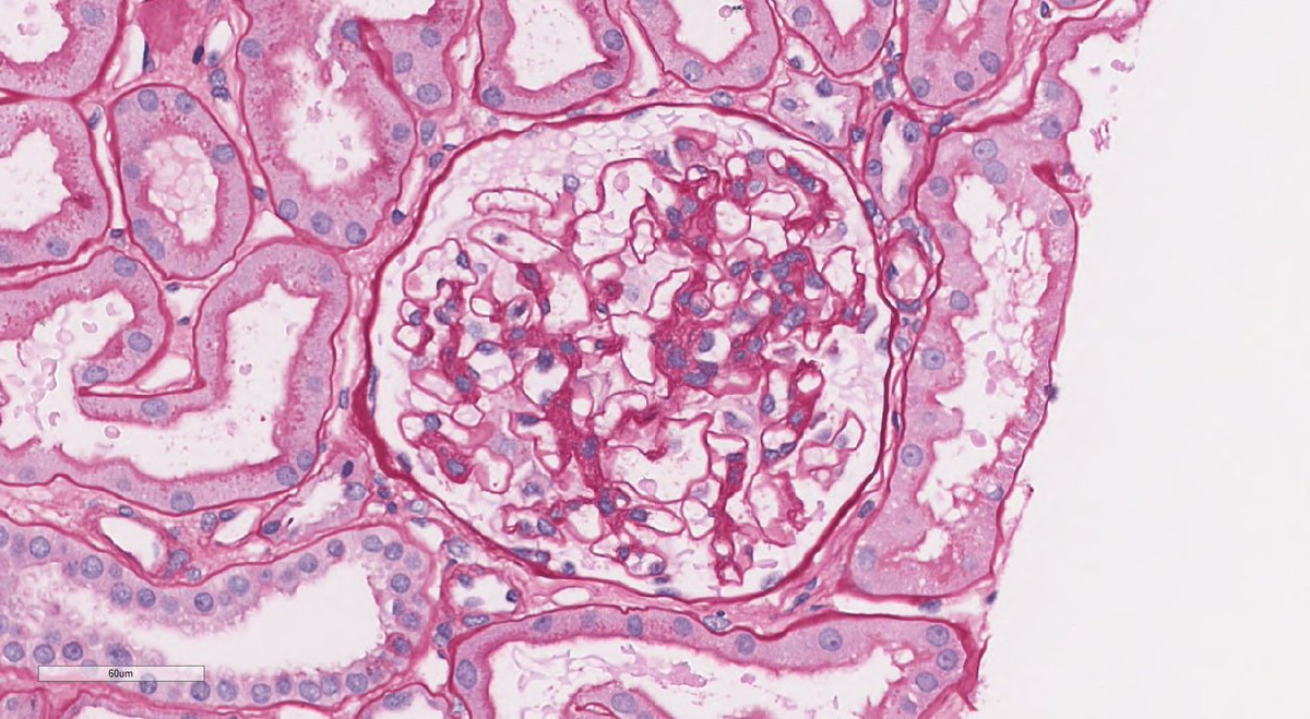 While I enjoy interesting and challenging cases, I'm certainly glad for the bread and butter cases that come across my desk, such as this case of IgAN in a pt with hematuria and proteinuria. Mesangial IgA deposits and mild mesangial hypercellularity.  #renalpath #pathtwitter