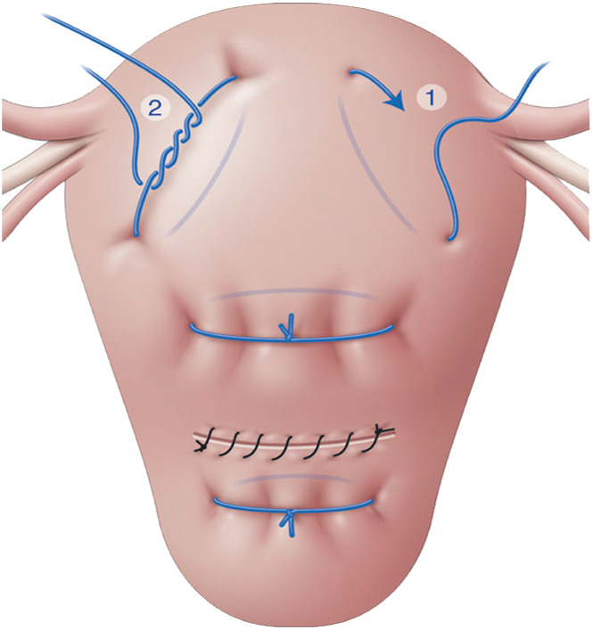 AJOG Expert Review in Labor: Uterine-sparing surgical procedures to control postpartum hemorrhage - Ouahba’s uterine compression sutures: Technique based on 4 sutures ow.ly/L98250RgJyv