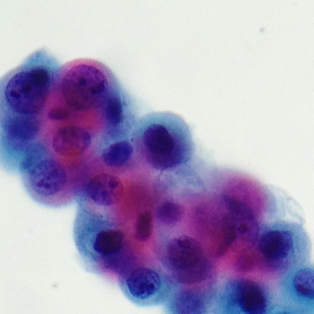 Pathologist_EZ's tweet photo. Mesothelioma #PathTwitter #pathologists #pathology #pathologytwitter https://t.co/GLWVpzLaKb