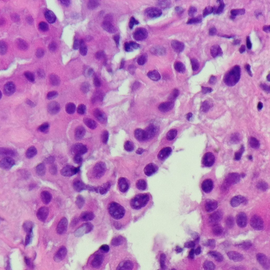 Pathologist_EZ's tweet photo. Mesothelioma #PathTwitter #pathologists #pathology #pathologytwitter https://t.co/GLWVpzLaKb