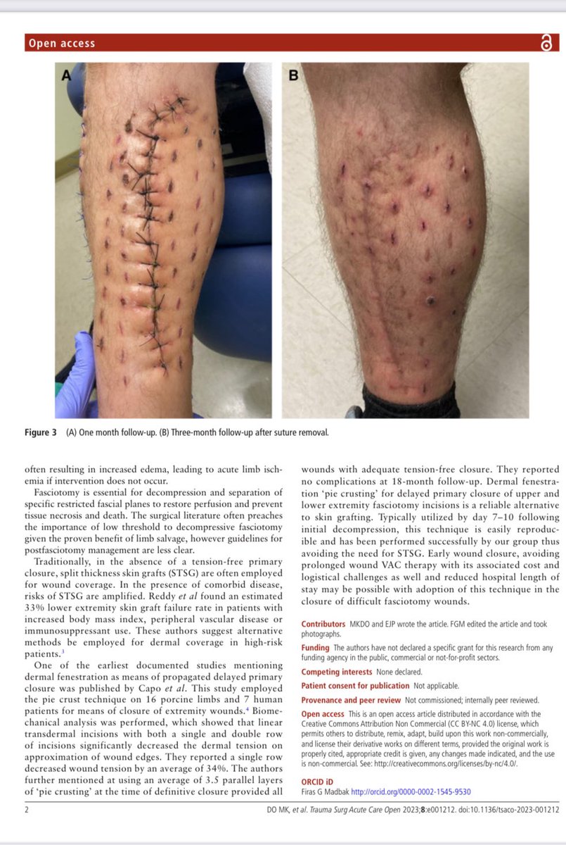Thanks @DrJtrauma for citing  “Dermal fenestration ‘pie crust’ technique for difficult fasciotomy closures” in @TSACO_AAST #TCCACS2024 #TCCACS24 

tsaco.bmj.com/content/8/1/e0…