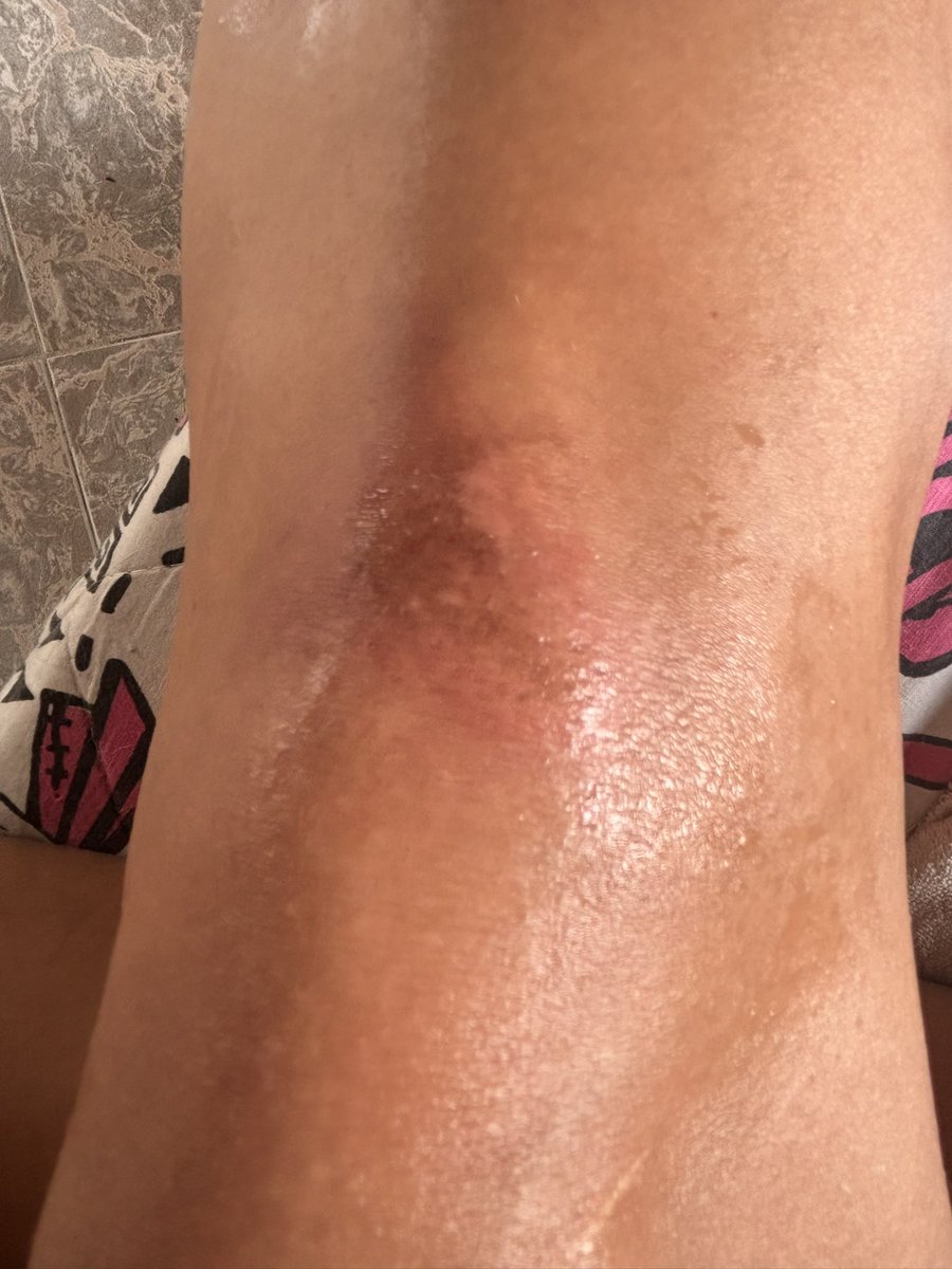 EllyWinter11's tweet photo. Una nena mimada porque se cayó el día de hoy y se lastimó su rodilla. 😭🥺 https://t.co/XYhSNuWbeZ