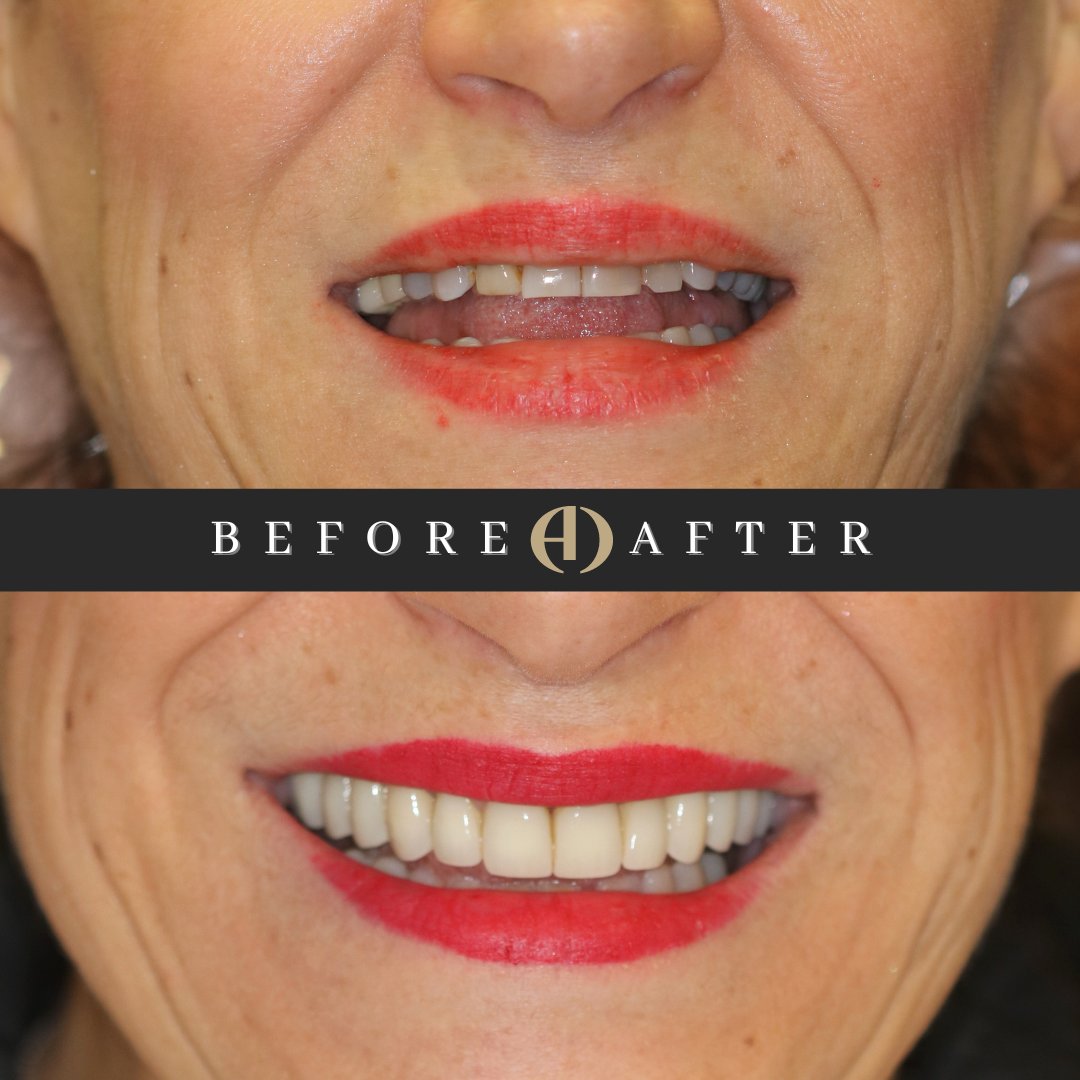 Cosmetic makeover #MakeoverMonday
Treatment done by Dr Dean Chencharik @cosmetickingdmd
.
.
#dentist #dentistry #dental #cosmetic #cosmeticdentistry #nj #newjersey #veneers #laminates #crown #dentalcrown #dentalimplants #smile #smiles #teeth #tooth #rdh #dentalhygienist