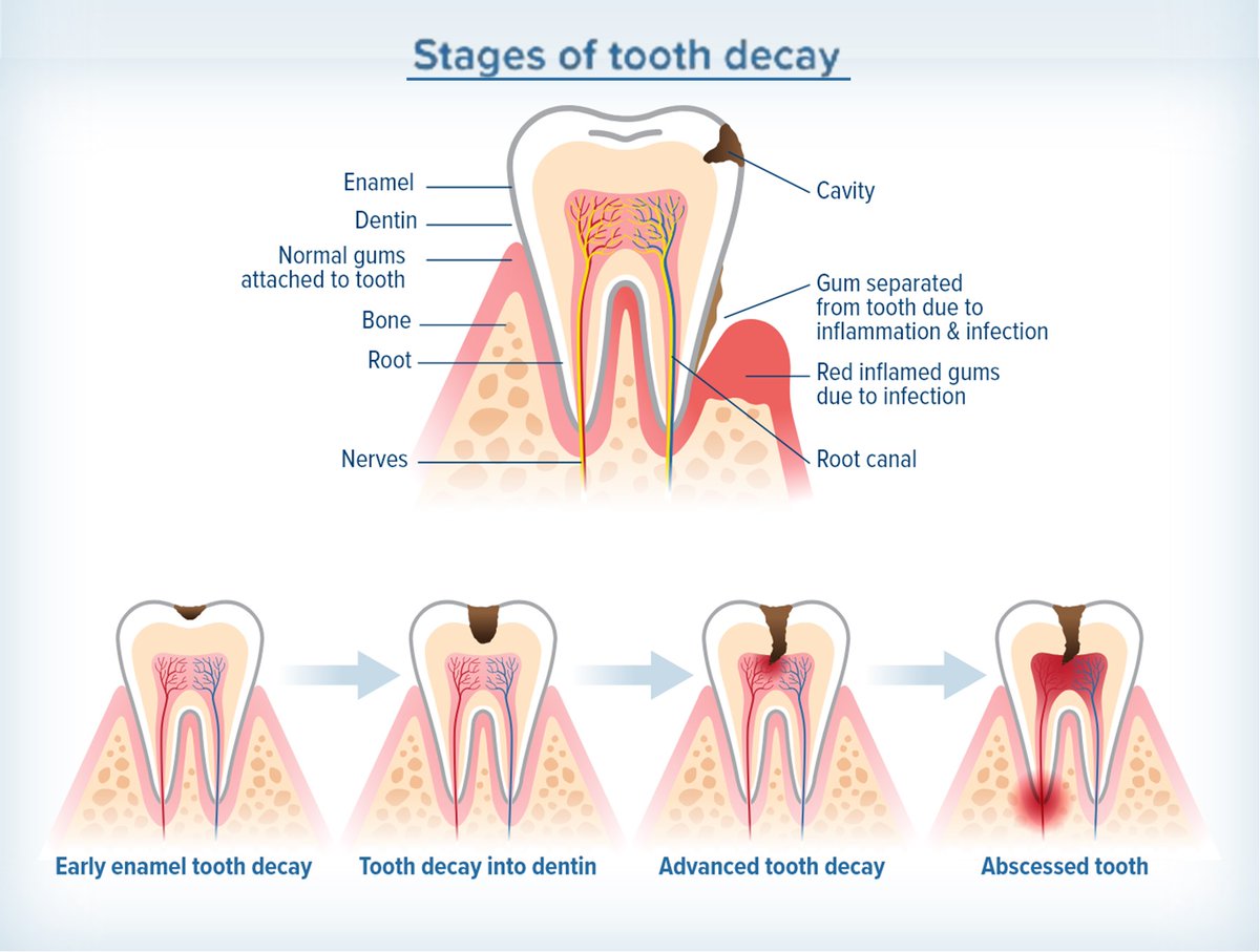 Infograph showing the Stages of Tooth Decay.

#flossdental #thetoothdr #flossboss #careoregondental #infograph #toothdecay #dentist #dentistry #trinidadandtobago