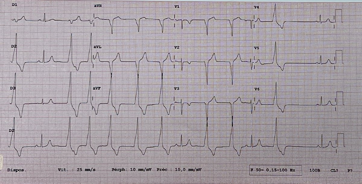 ECG of a 17 yo student with several months of palpitations, dizziness and occasional chest pain. No syncopes. Normal CMR. #Cardiology #CardioTwitter. Check out the poll #Epeeps @Hapa_EP @melhamriti @ArashArya_EP @DrV_Mann @ugurcanpolatmd @WaintraubX @rythmo_sfc @AGEP_DGK