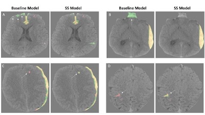 Semisupervised learning achieved stronger generalization for intracranial hemorrhage classification and segmentation on head CT doi.org/10.1148/ryai.2… @UCSFimaging #NeuroRad #AI #ML