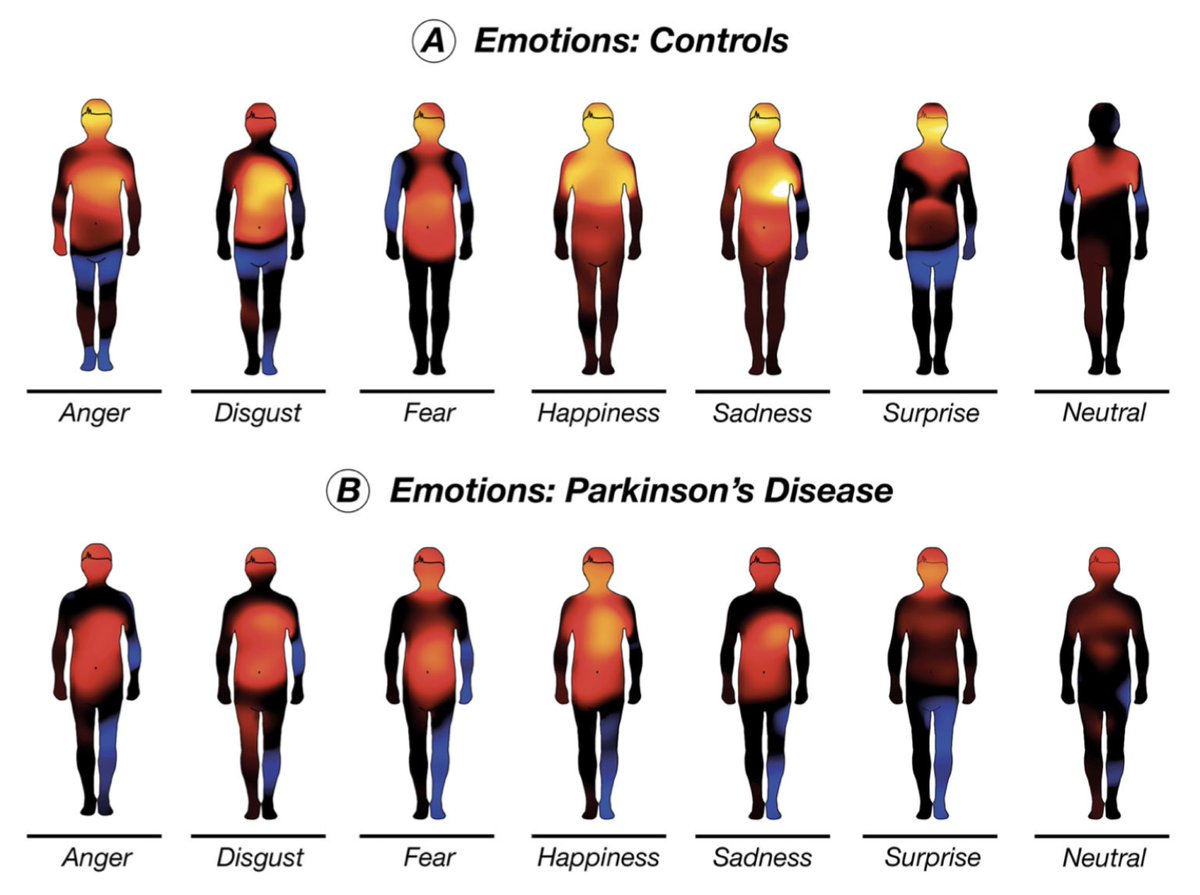 Emotion puts bodies in motion, and our new paper shows how corporal emotions are altered in movement disorders. A collaborative effort between Emotion Lab @TurkuPETCentre and @JJoutsa group now out in @MDJ_Journal doi.org/10.1002/mds.29… 👇