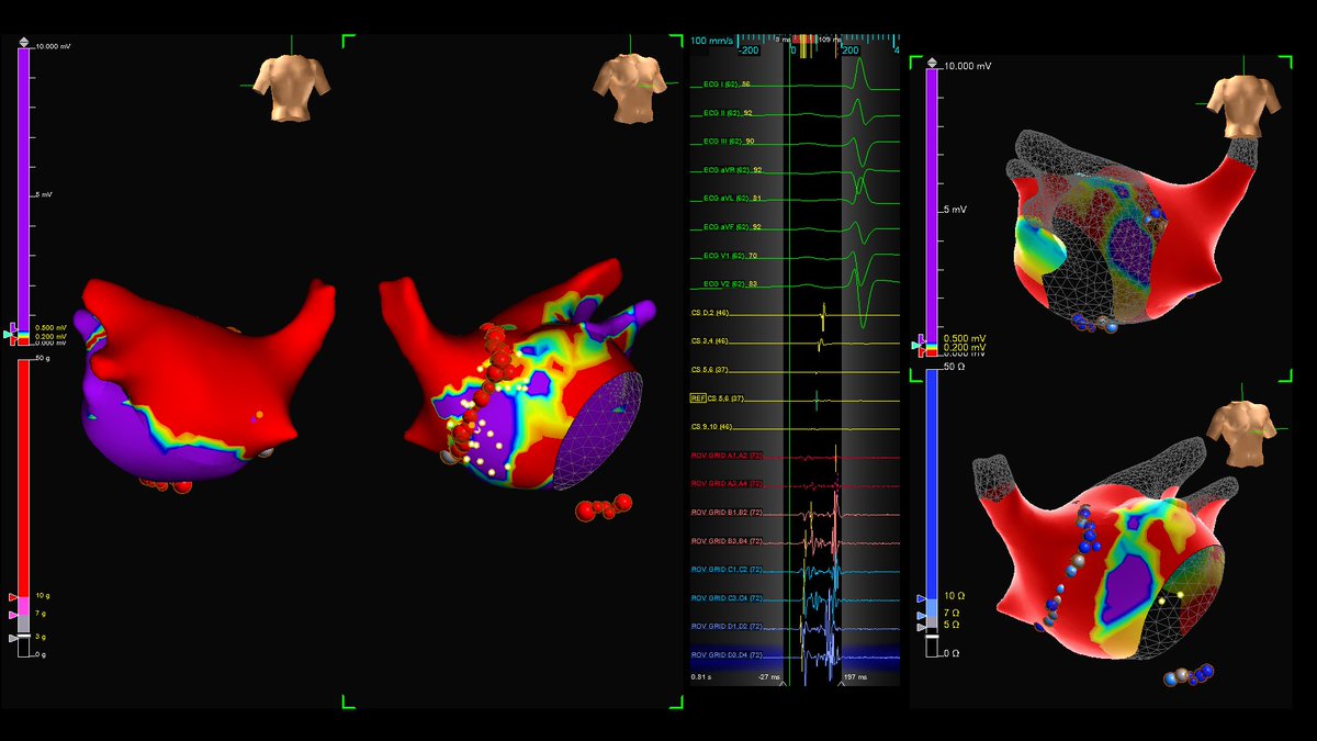 Cryo &amp; RF for PVI + PW + CTI in 2021. 

AF cardioverted, SR mapped, Voltage with Fractionation map highlighting RPV antrum ablated.

Veins and Posterior Wall remain isolated, CTI assessed conduction leak at annulus.

<a href="/EPS_PDX/">D Randy Jones</a> 

#PMA #TactiFlex