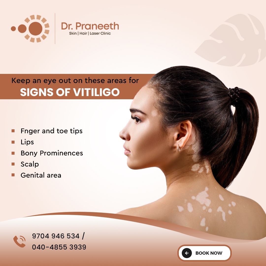 Keep an eye out for signs of #Vitiligo ! Our #ExpertAssistance at @DrPraneethKumar  is here to guide you. 
Call us at 9704 946 534 
Book your appointment now at drpraneethclinic.com

#drpraneethclinic #beauty  #Hyderabad  #kphb #kphbcolony #clinics #Trending #postoftheday