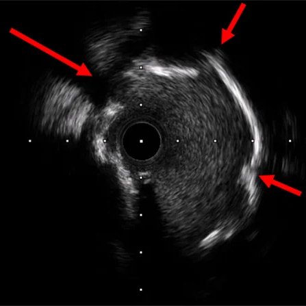 Crossing the uncrossable! View part 2⃣ of this #Euro4C case showing how a team from University Heart Center Graz 🇦🇹 managed an uncrossable calcified lesion complicated with iatrogenic ostial dissection🔗 pcronline.com/Cases-resource… Shared by @andreka_judit @gabor_gt Günther…