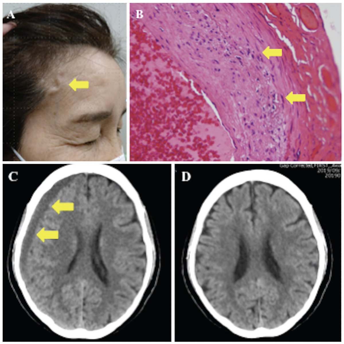 alb_giraldo's tweet photo. Although it is rare, chronic #subdural #hematoma may occur in patients with giant cell #arteritis, probably due to vasculitic damage of small subdural arteries. This should be considered specially when headaches persist despite starting steroid therapy.
🔗https://t.co/RZn5RE4ZMn https://t.co/6s6ot67qsp