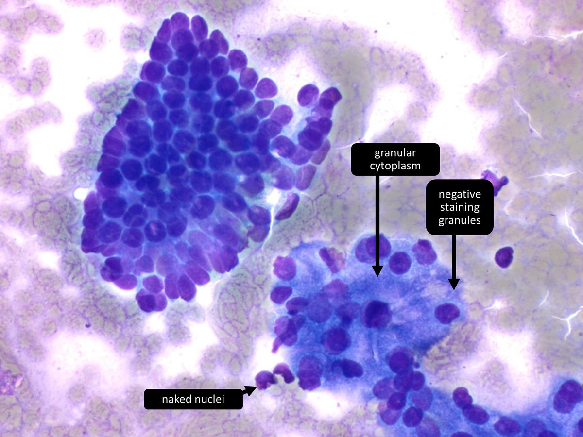 Pancreatic mass. Diagnosis? A) Non-diagnostic B) Negative (for malignancy) C) Neoplastic (benign or other) D) Malignant #cytopath #pathology #gipath #pathtwitter