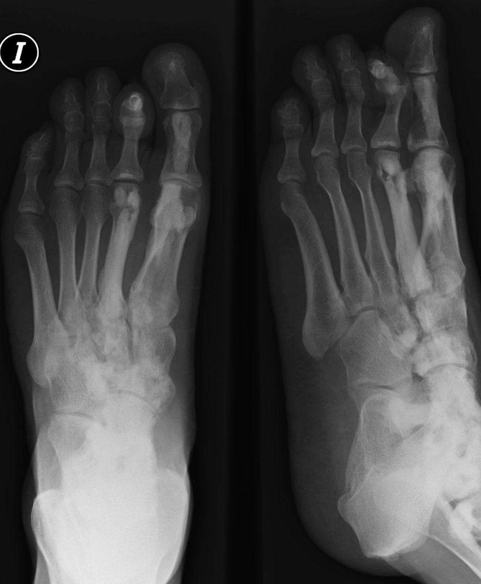 Incidental finding on dorsoplantar and oblique radiographs of the foot after minor trauma. The radiological appearance and distribution of the findings are key to the diagnosis. Any thoughts? Which bones are affected? #FOAMed #MedEd