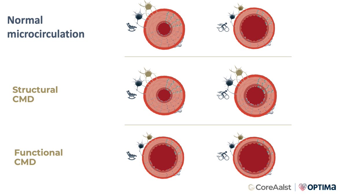 M I C R O V A S C U L A R D I S E A S E in focus 🔬 🌟 Dr D I V A K A P E R E R A presents: C M D : Does it exist? 🤔❓❓ The Physiology Course 16th edition: A New Wave! 🗓️ April 15-17, 2024 📍 @orsiacademy 🇧🇪 🔗 coreaalst.com/physiology #ANewWave #ORSIAcademy