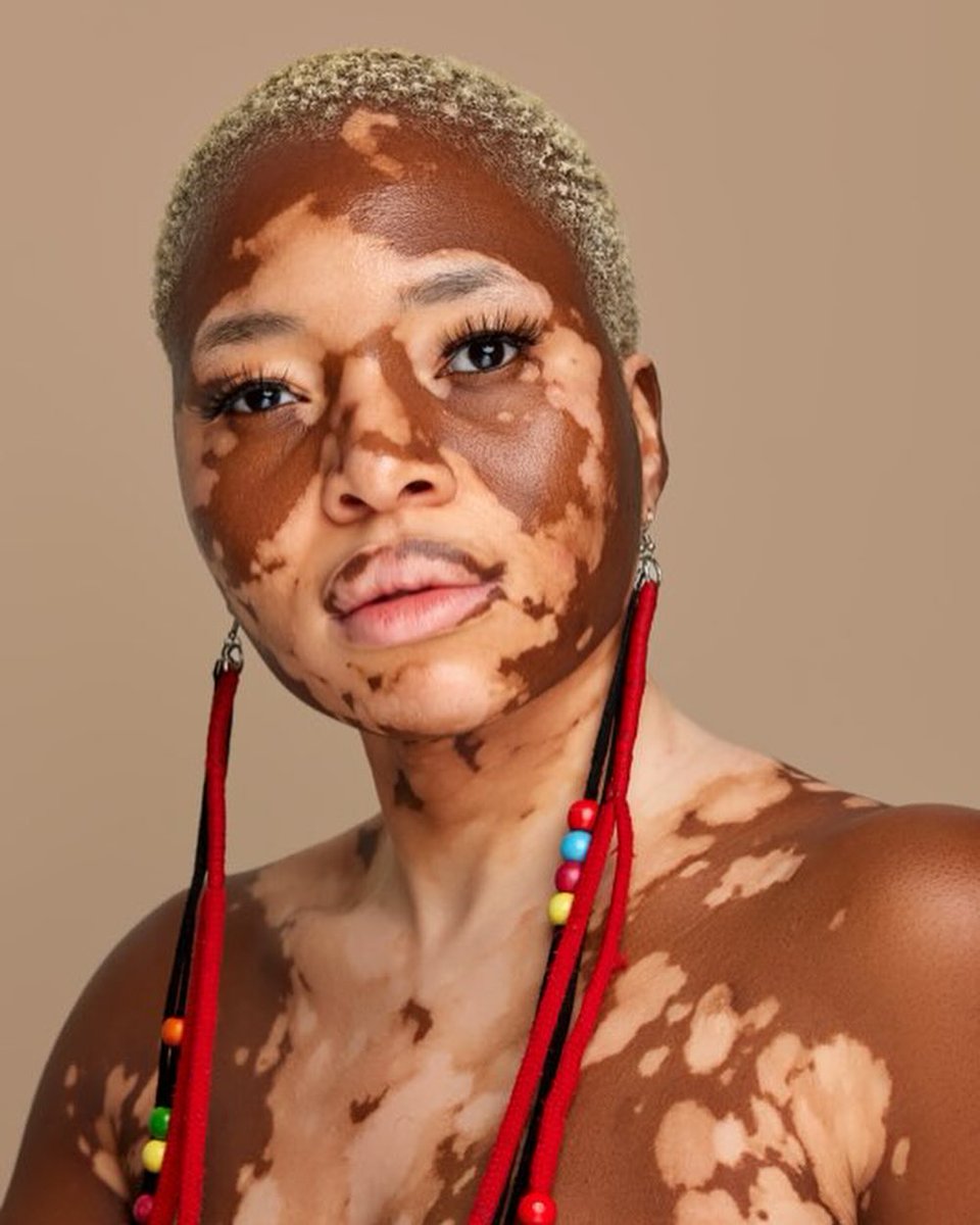 brieflyza's tweet photo. Big Brother Mzansi housemate, Yolanda has embraced her skin condition called Vitiligo with grace😍

Taking to her socials she wrote, "There is beauty in everything."

She is beautiful!

@yolandamukondi #brieflyza #celebnewsupdates #BBMzansi https://t.co/mc8njEoIlT