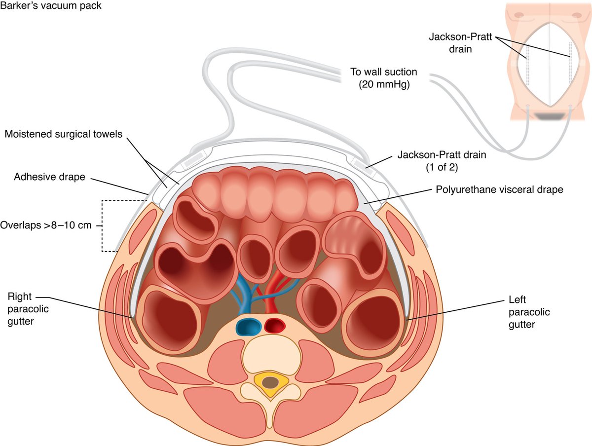 Today's Paper of the Day is on the open abdomen in trauma, acute care, and vascular and endovascular surgery criticalcarereviews.com/latest-evidenc… Join us to read 1 paper per day and stay up-to-date as we cover the spectrum of critical care across 2024