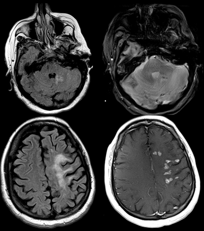 1/ Sometime the findings are not always so obvious & can be seen outside the brain🧠
✳️A case of Parry-Romberg syndrome (image 1) - Left frontal bone & overlying scalp defect was the only finding 👀
🧒Rare craniofacial phakomatosis with progressive facial hemiatrophy

#neurorad