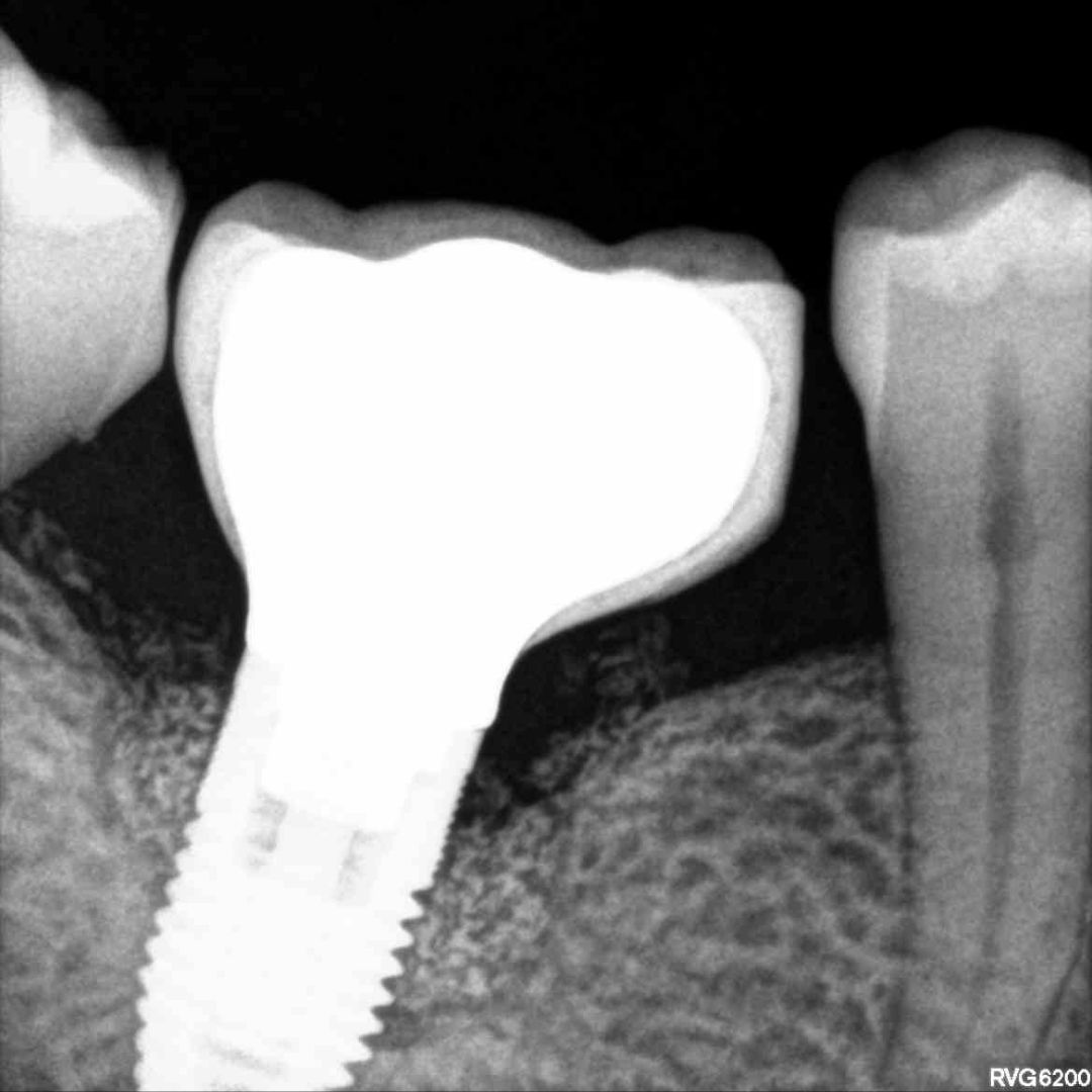 esmatges's tweet photo. #CASOCLÍNICO
CASO 25
TRATAMIENTO QUIRÚRGICO PERIIMPLANTITIS (XENOINJERTO + MEMBRANA)

#Esmatges #EsmatgesPeriodoncia #clinicadental #exodoncia #preservacion #Periodoncia #Genives #Encias #pacientes #Lleida #periimplantitis #tratamientoquirurgico #xenoinjerto https://t.co/dWNeWoCBfL