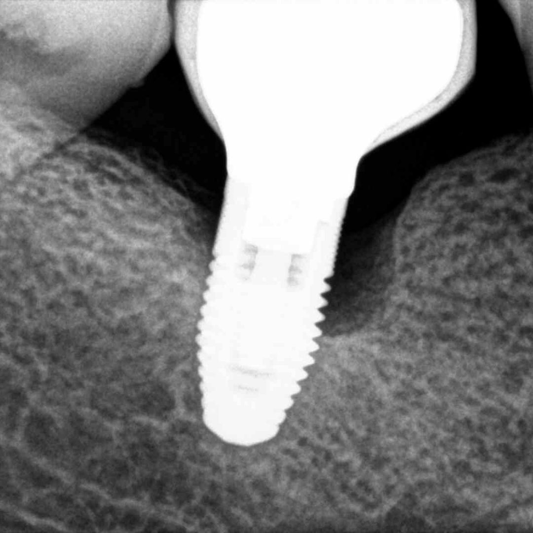 esmatges's tweet photo. #CASOCLÍNICO
CASO 25
TRATAMIENTO QUIRÚRGICO PERIIMPLANTITIS (XENOINJERTO + MEMBRANA)

#Esmatges #EsmatgesPeriodoncia #clinicadental #exodoncia #preservacion #Periodoncia #Genives #Encias #pacientes #Lleida #periimplantitis #tratamientoquirurgico #xenoinjerto https://t.co/dWNeWoCBfL