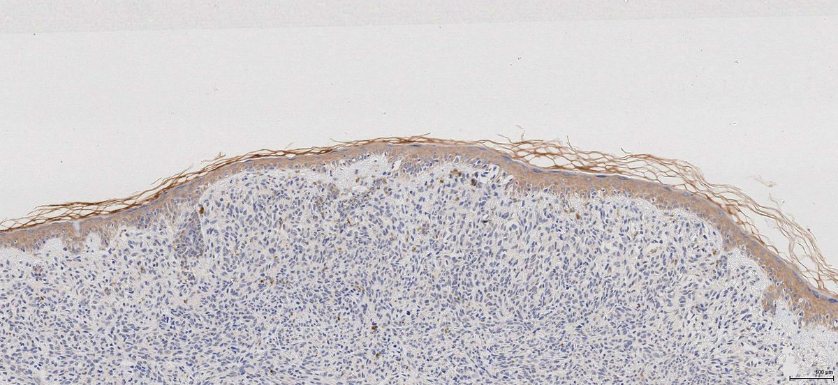 A US study shows an increase in immunohistochemistry to help decision making in #melanoma patients aged 65+. bit.ly/43EpVmq We believe IHC can provide prognostic information to help avoid invasive diagnostic procedures, lengthy follow-up, or unnecessary treatment.